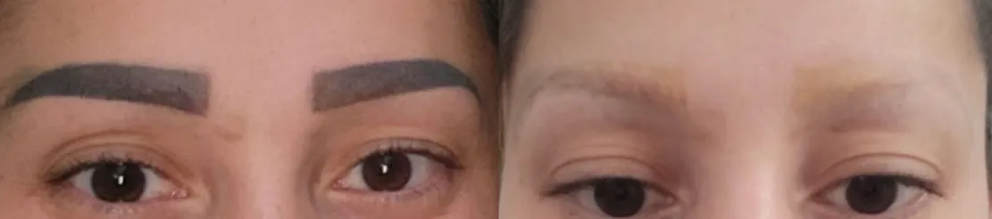 Vorher-Nachher Foto einer Microblading-Entfernung nach 4 Behandlungen in Frauenfeld