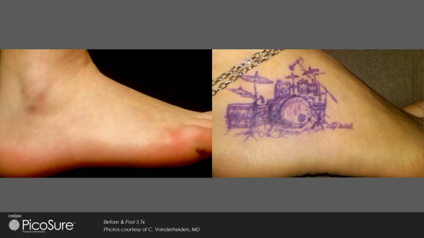 Vorher-Nachher Foto einer Tattooentfernung nach nur 5 Behandlungen mit dem Pico-Sure-Laser