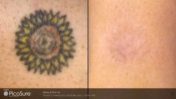 Vorher-Nachher Foto einer Tattooentfernung nach nur 4 Behandlungen mit dem Pico-Sure-Laser