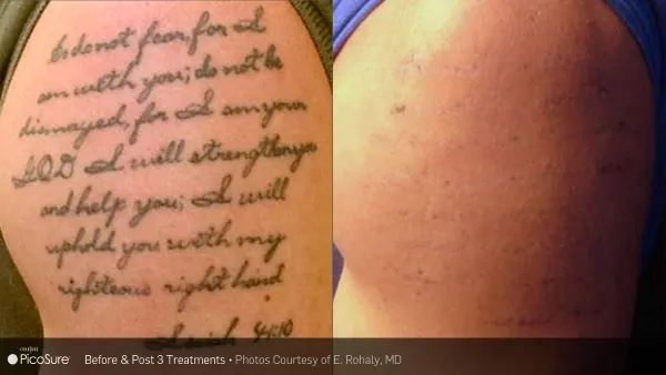 Vorher-Nachher Foto einer Tattooentfernung nach nur 3 Behandlungen mit dem Pico-Sure-Laser