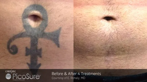 Vorher-Nachher Foto einer Tattooentfernung nach nur 4 Behandlungen mit dem Pico-Sure-Laser