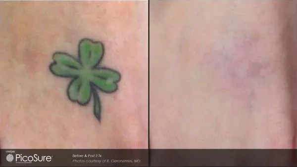 Vorher-Nachher Foto einer Tattooentfernung nach nur 3 Behandlungen mit dem Pico-Sure-Laser