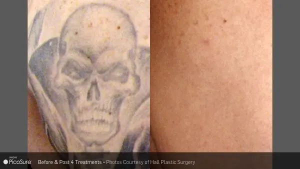 Vorher-Nachher Foto einer Tattooentfernung nach 4 Behandlungen