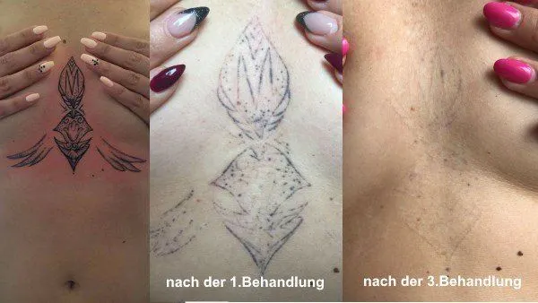 Vorher-Nachher Foto einer Tattooentfernung nach 3 Behandlungen
