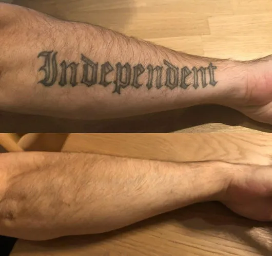 Tattooentfernung nach 6 Behandlungen mit dem PicoSure-Laser in Frauenfeld